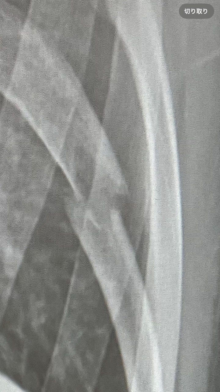 肋骨骨折拡大の図。現在もこのまま固定