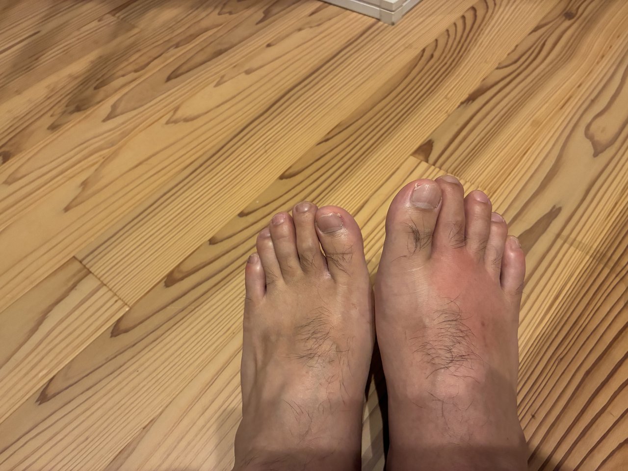 木のフローリングの上に並べた両足を上から撮影。右足の甲が赤く腫れている様子がわかる